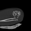 SPORK, NICO - 22.03.1976 - 02.08.2022 - CT obere Extremität - 18:02:23